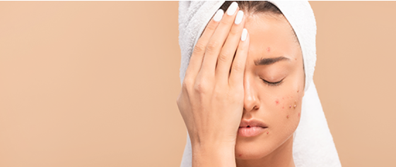 Setze deiner Akne ein Ende!