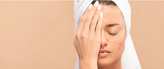 Put an end to your acne!