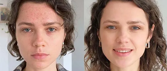 Acne: What happens in the skin and how can you help?