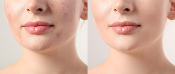 Akne bekämpfen: Tipps und Heilmittel für reine Haut