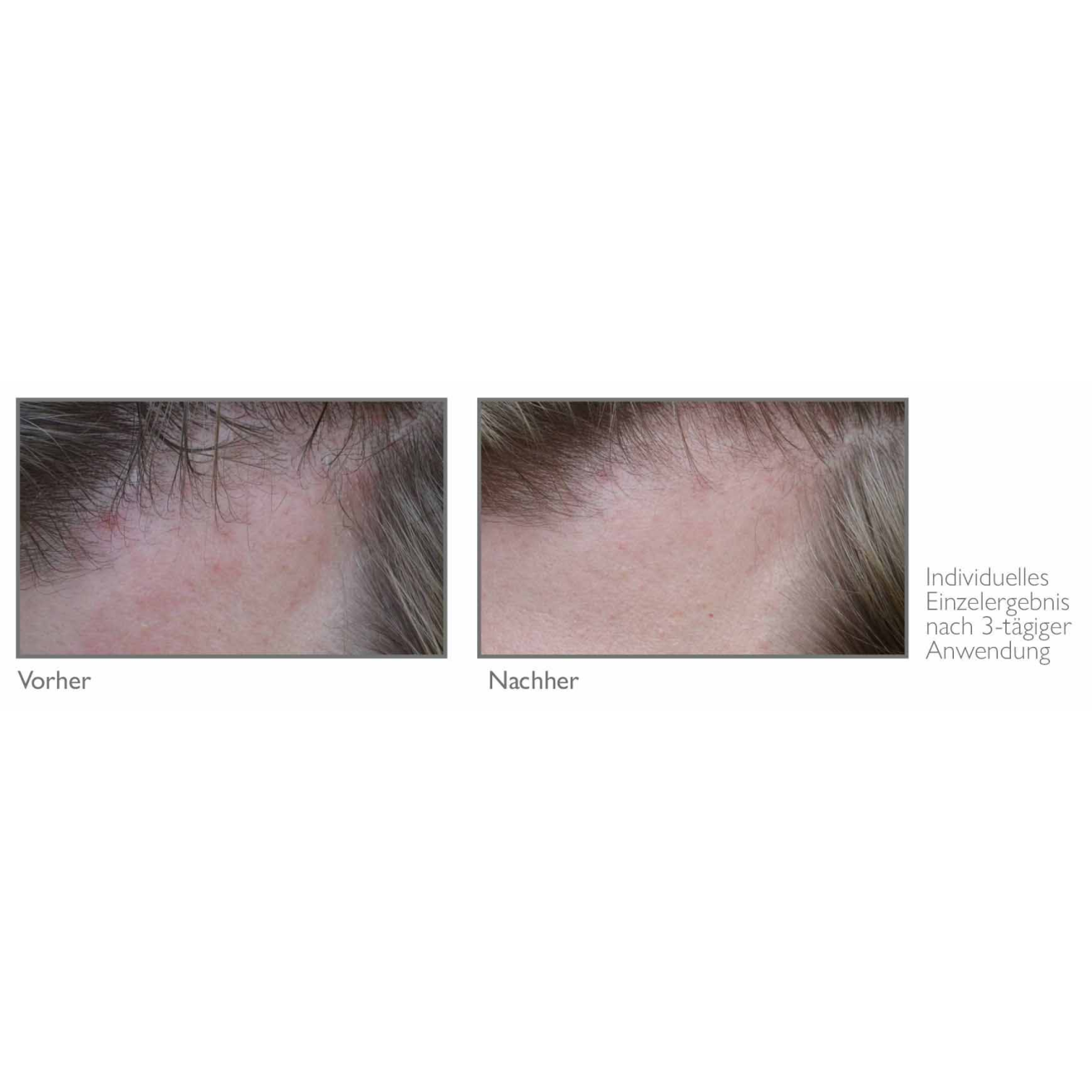 dandruff and itching