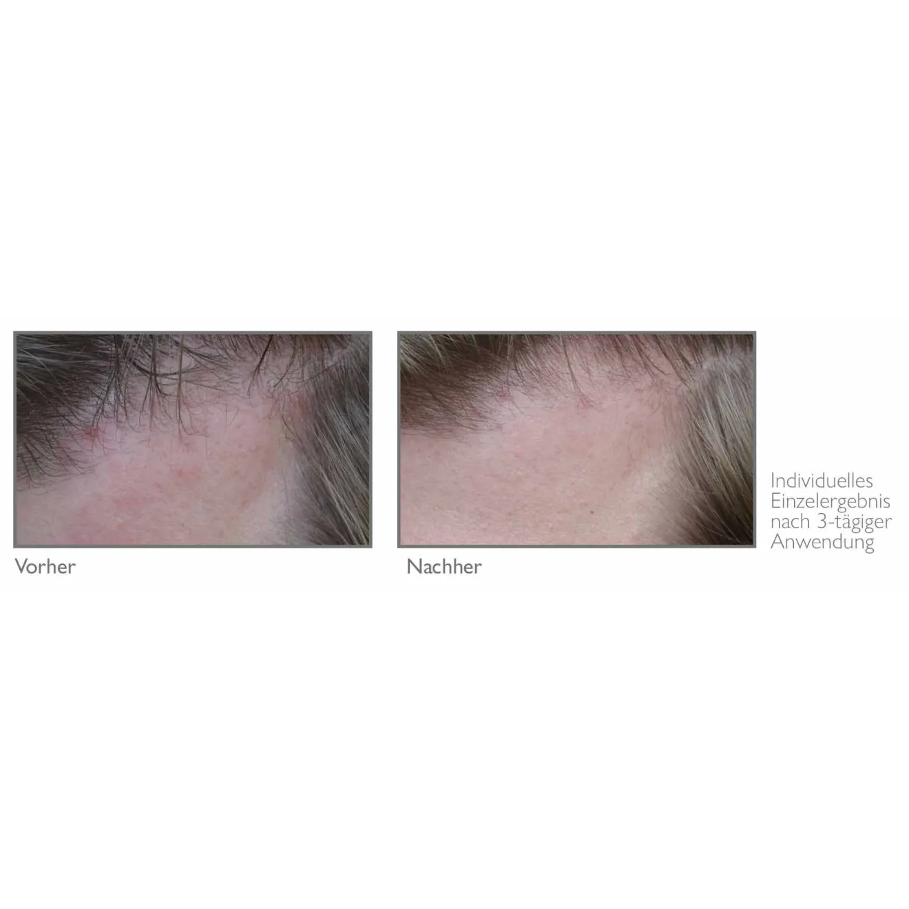 Hilft bei Schuppen und Juckreiz