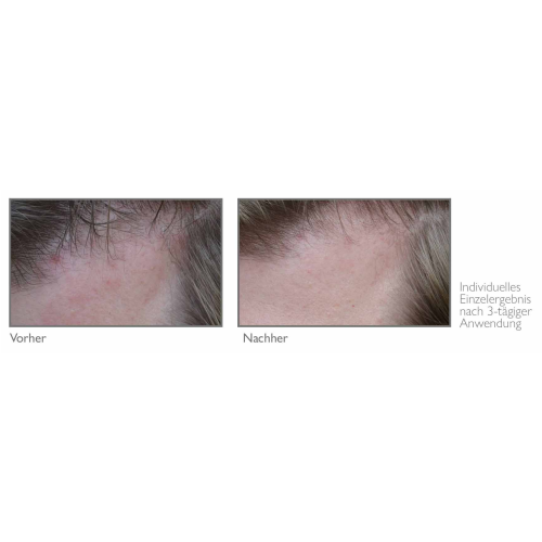 dandruff and itching