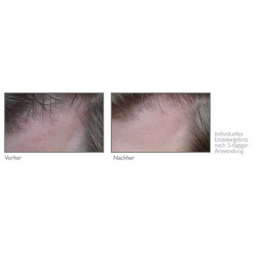 Hilft bei Schuppen und Juckreiz